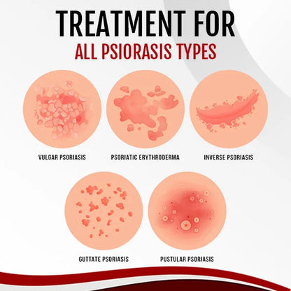 AnnieCare® Psoriasis Treatment Spray（Visible Change in 1 week!）