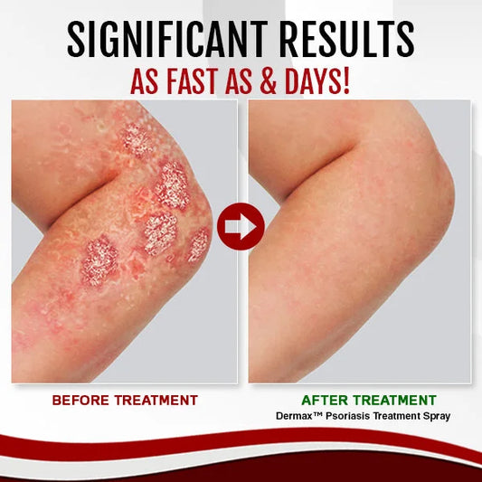AnnieCare® Psoriasis Treatment Spray（Visible Change in 1 week!）
