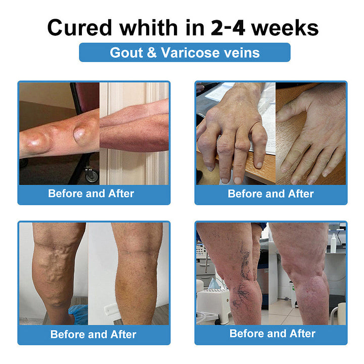 Official Store：👩‍⚕️Recommended by AAOS🏃‍♂️‍➡️AnnieCare® Nano-microneedle joint patch (Painless, long-lasting, suitable for arthritis, varicose veins and various orthopedic diseases)