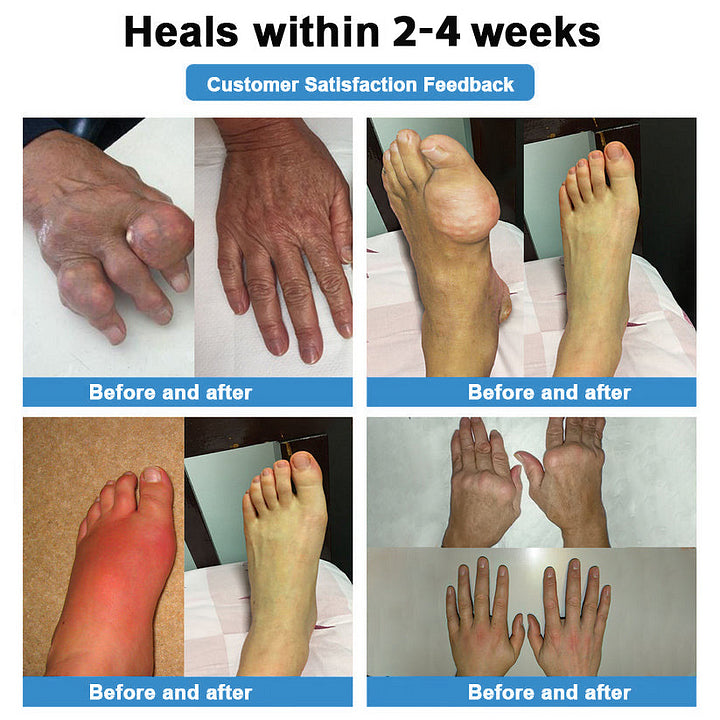 Official Store：👩‍⚕️Recommended by AAOS🏃‍♂️‍➡️AnnieCare® Nano-microneedle joint patch (Painless, long-lasting, suitable for arthritis, varicose veins and various orthopedic diseases)