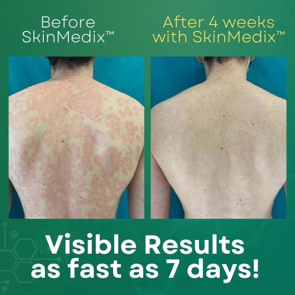 SkinMedix™ Natural Herbaceous Plants Psoriasis Cream(Visible change in one week!)