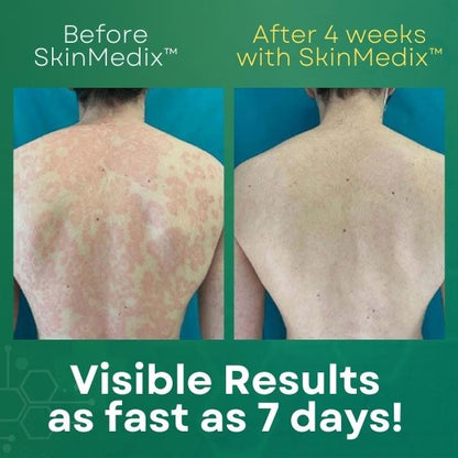 SkinMedix™ Natural Herbaceous Plants Psoriasis Cream(Visible change in one week!)